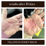 The best tallow and honey balm for eczema, dry skin, cracked hands. Skin repair within a few days.