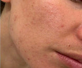 before picture of using tallow lotion