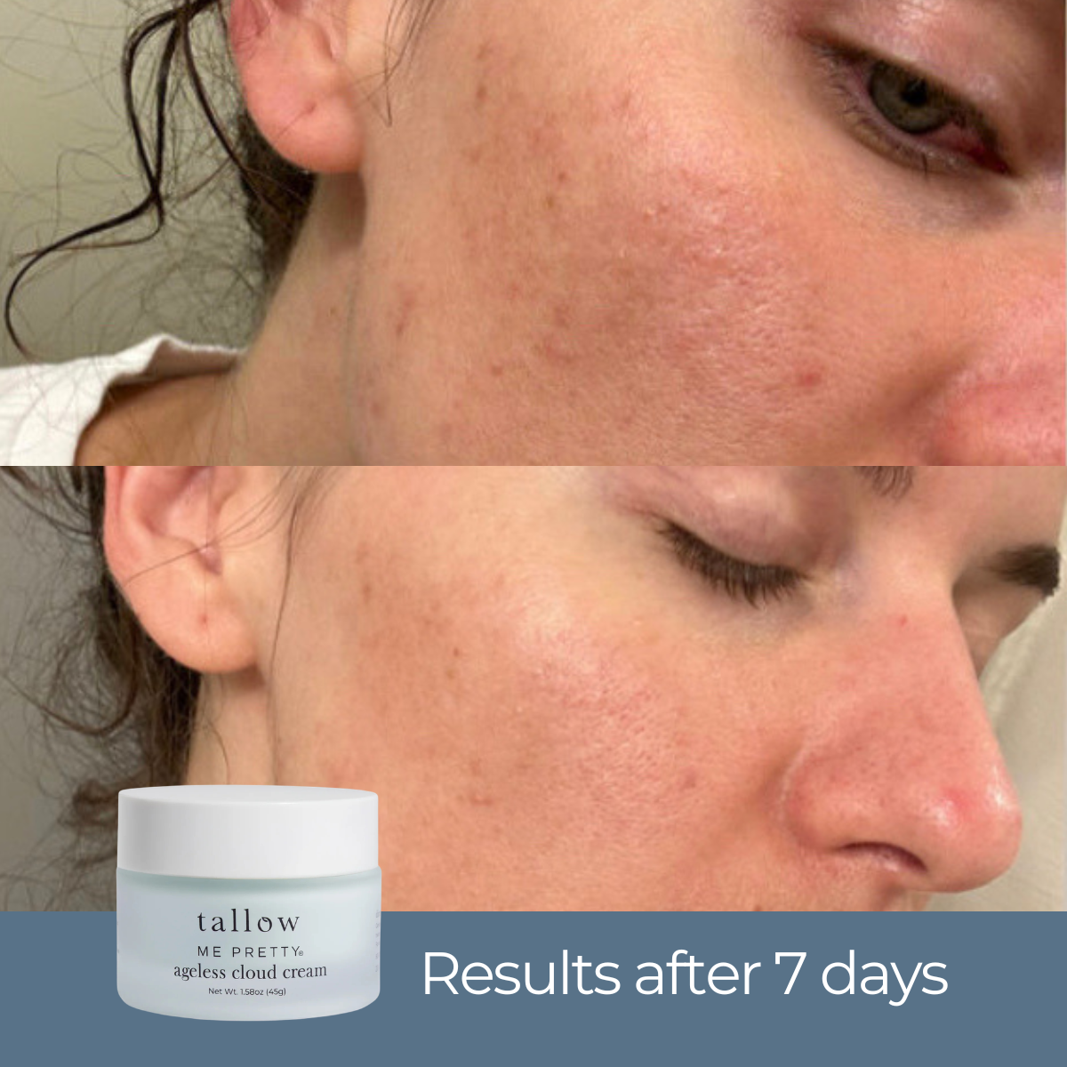 Before-and-after split screen showing a woman's face with acne improvement over 7 days, with a small jar of tallow ME PRETTI acne cloud cream at the bottom left.