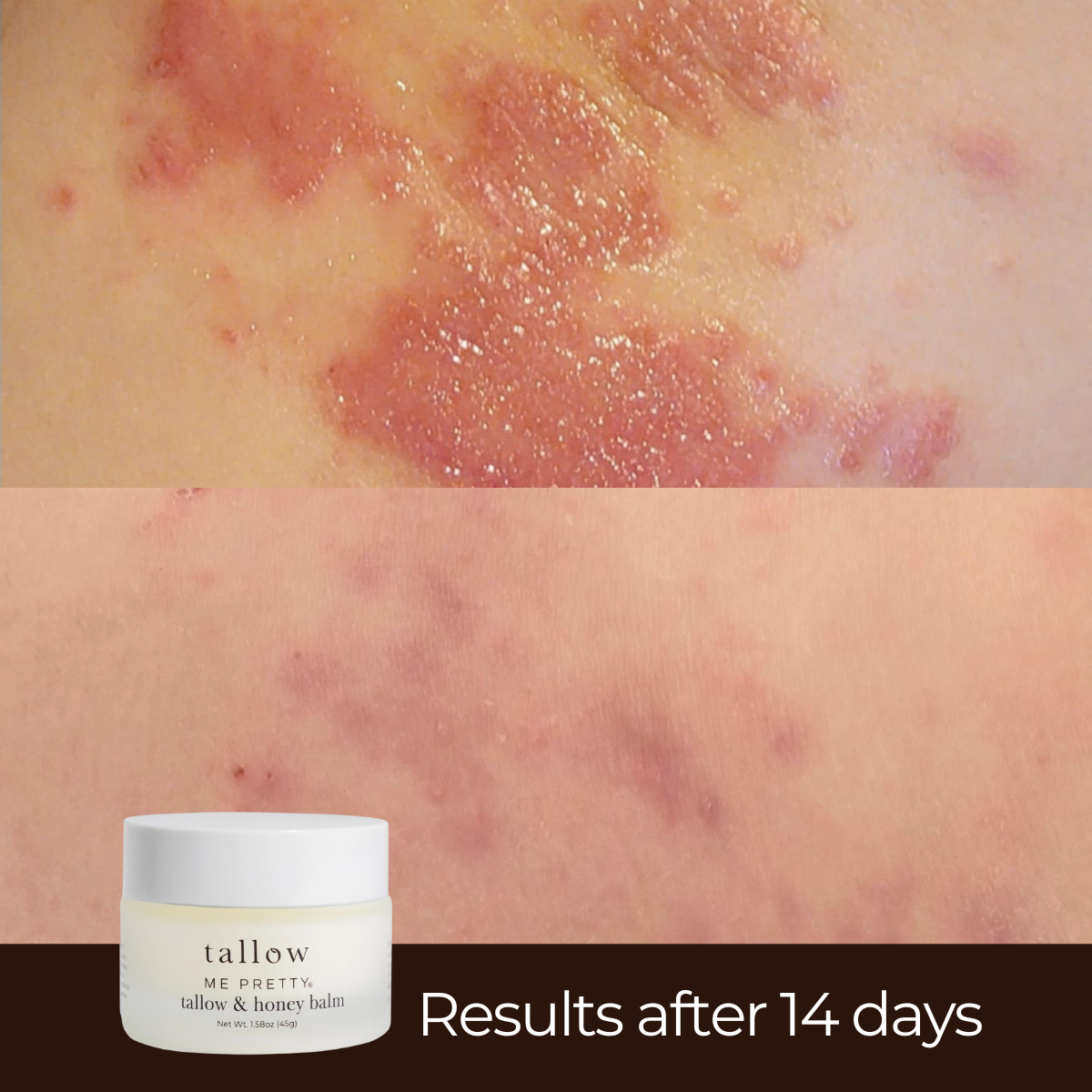Before-and-after skin comparison showing a reduction in red, irritated skin, with a small white jar of tallow Me Pretty honey balm at the bottom left and the text 'Results after 14 days' on a dark banner.