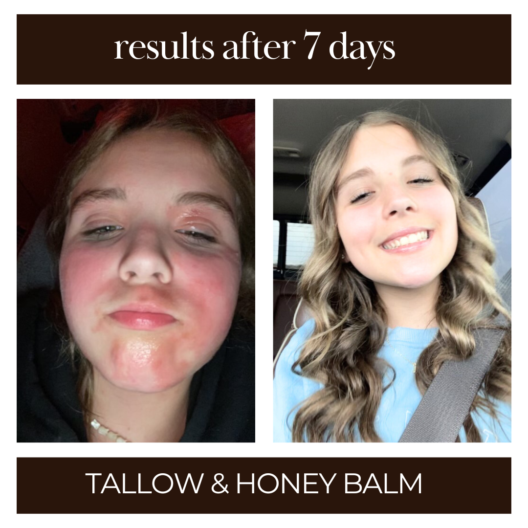tallow and honey balm before and after of red, inflamed, eczema on face. best tallow and honey balm. Overall pick on Amazon. 