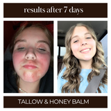 tallow and honey balm before and after of red, inflamed, eczema on face. best tallow and honey balm. Overall pick on Amazon. 