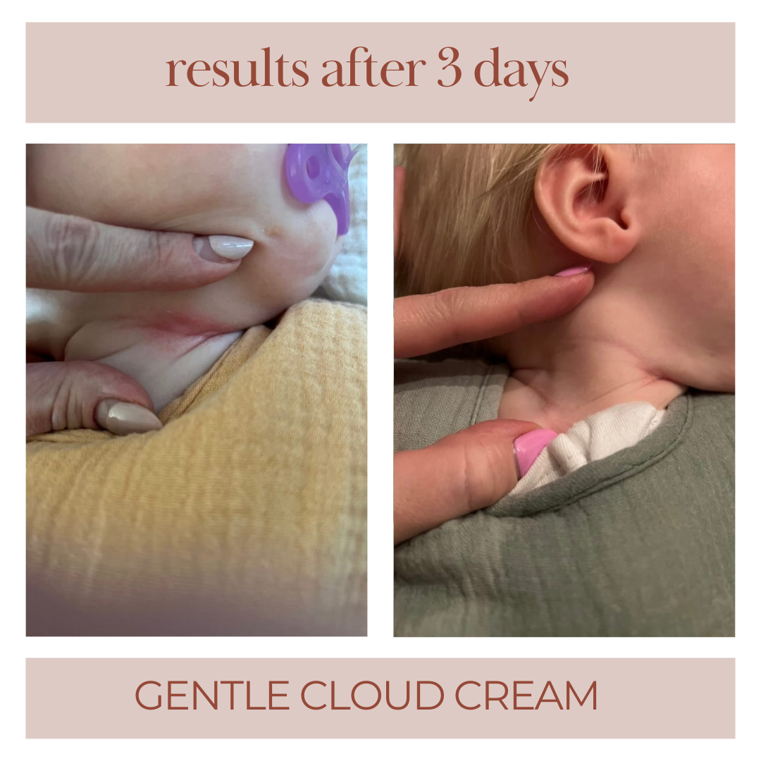 gentle cloud cream before and after photo of baby that has redness on her neck. results after three days showing reduced skin inflammation. 