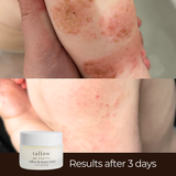 Tallow and honey balm for body eczema rash — calmed skin after 3 days
