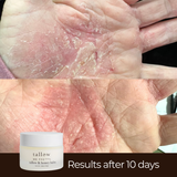 Tallow and honey balm eczema results — dry cracked hand skin healed after 10 days