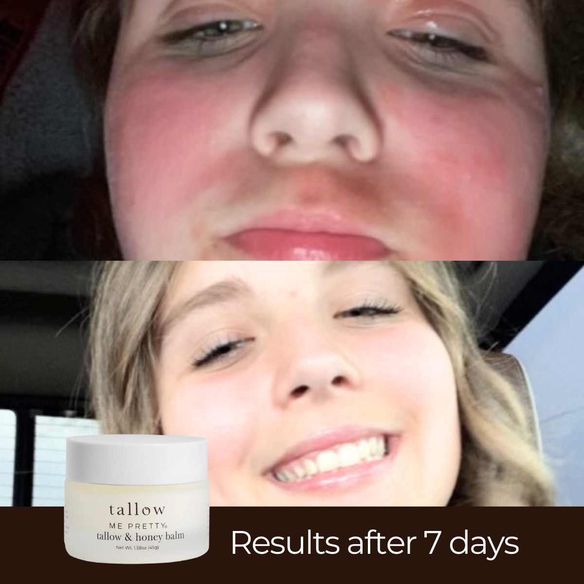 Tallow and honey balm for facial redness and irritation — visible results after 7 days
