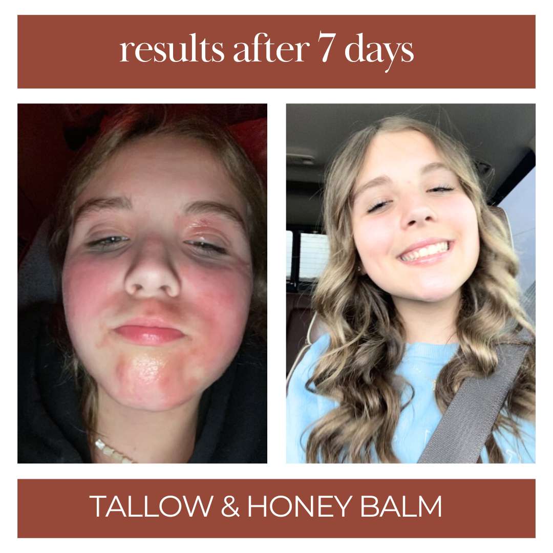 tallow and honey balm before and after of red, inflamed, eczema on face. best tallow and honey balm. Overall pick on Amazon. 