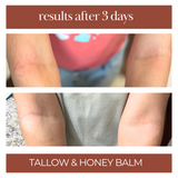 tallow and honey balm for eczema relief, dry skin, red skin, itchy skin.