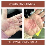 The best tallow and honey balm for eczema, dry skin, cracked hands. Skin repair within a few days. 