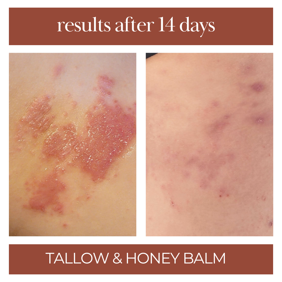 tallow and honey balm that relieves rosacea, dry skin, inflammed skin. 