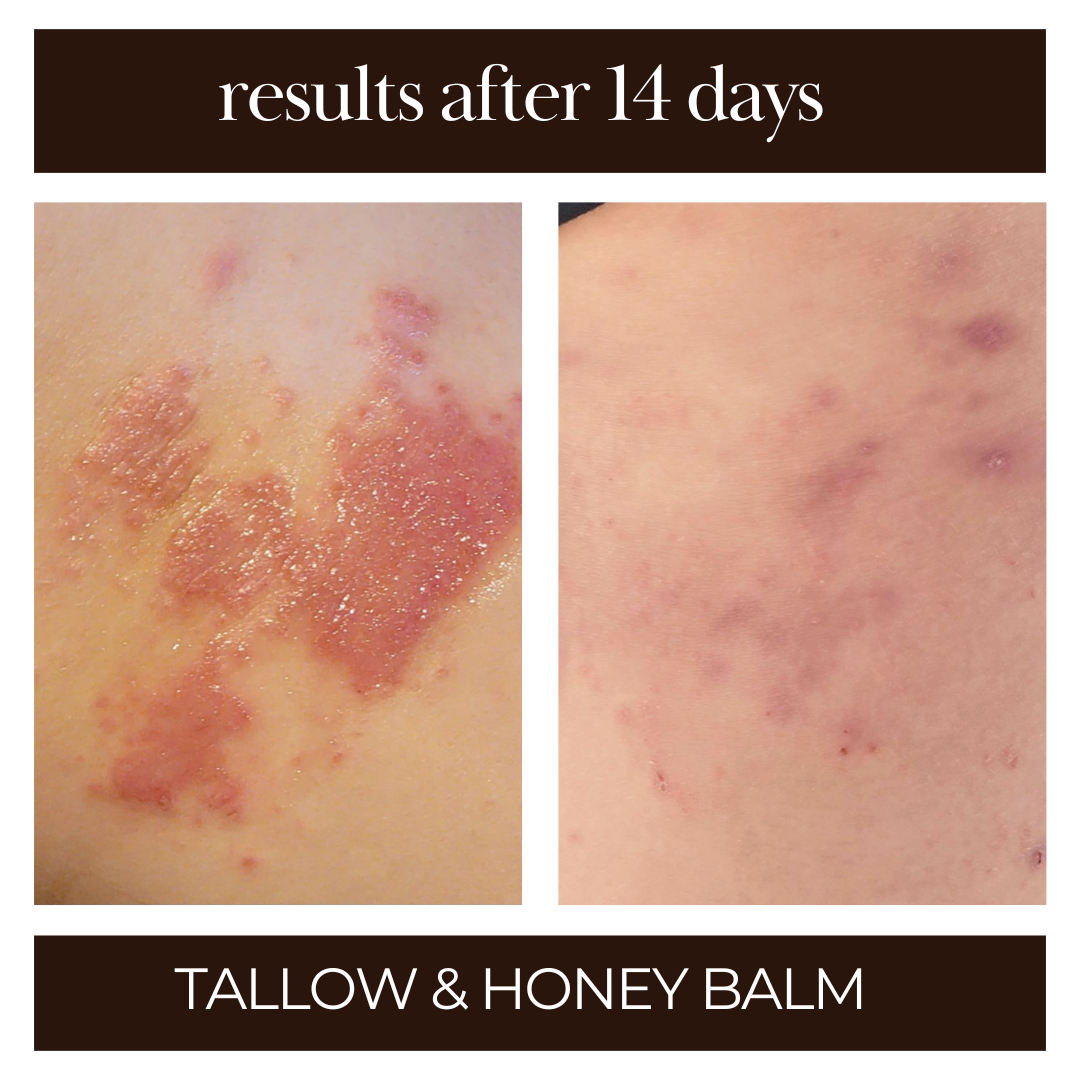 tallow and honey balm that relieves rosacea, dry skin, inflammed skin. 