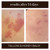 tallow and honey balm that relieves rosacea, dry skin, inflammed skin. 